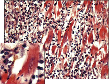 Figur 3  Histologisk preparat fra v&aring;r pasient viser myokarditt. Infiltratet best&aring;r av tallrike mononukle&aelig;re celler, som&hellip;