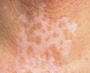 Figur 3  Perifollikul&aelig;r repigmentering. Det ses en rekke sirkul&aelig;re &laquo;&oslash;yer&raquo; av normalpigmentert hud, stedvis konfluert til&hellip;