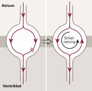 I venstre felt vises et prematurt atrieslag som ledes kun ned den langsomme banen. Innen impulsen n&aring;r His-bunten, er den&hellip;