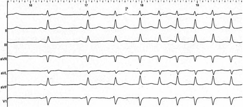 Figur 3  Atrioventrikul&aelig;r nodal reentrytakykardi starter med et atrialt prematurt slag (p) som gir skifte fra rask til&hellip;