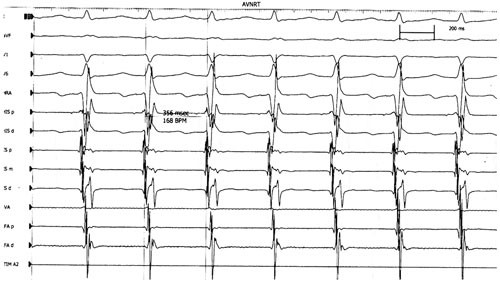 Figur 4  Intrakardial elektrofysiologisk registrering av p&aring;g&aring;ende atrioventrikul&aelig;r nodal reentrytakykardi med simultan&hellip;