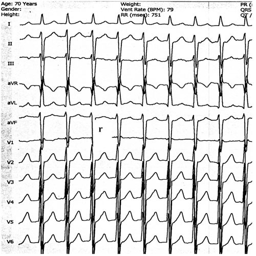 Figur 5  Atrioventrikul&aelig;r nodal reentrytakykardi med pseudo-r&rsquo;-b&oslash;lge i bakre del av QRS i V1, forenlig med P-b&oslash;lge i bakre&hellip;