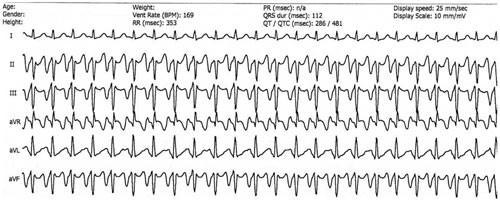 Figur 6  Atypisk atrioventrikul&aelig;r nodal reentrytakykardi med langt RP-intervall og negativ P i avledningene II, III og aVF