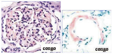 Figur 3  Nyrebiopsi. Kongofarging for amyloid