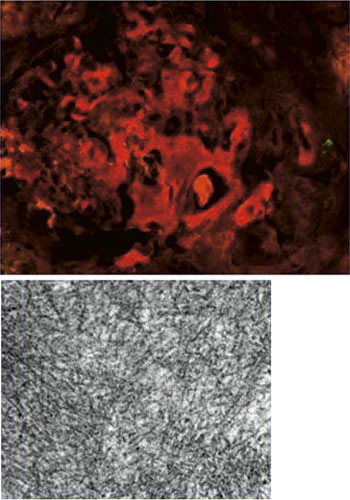 Figur 4  &Oslash;verste bilde viser glomerul&aelig;re nedslag av anti-&lambda;-positivt materiale (r&oslash;dt) ved immunfluorescens. Nederste bilde&hellip;