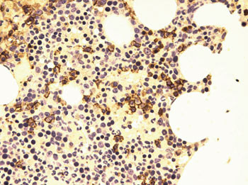 Figur 6  Beinmargsbiopsi. Immunfarging CD 138. Sm&aring; ansamlinger av plasmaceller