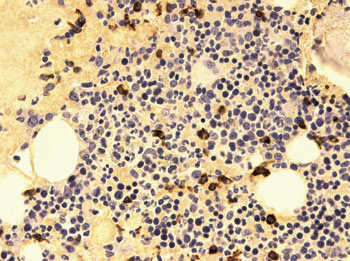 Figur 7  Beinmargsbiopsi. Immunfarging. Lette &lambda;-kjeder
