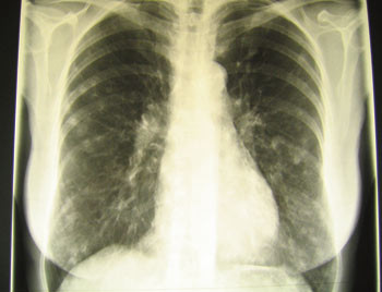 Figur 3  Histoplasmose: R&oslash;ntgen thorax hos en av pasientene 13 dager etter symptomstart