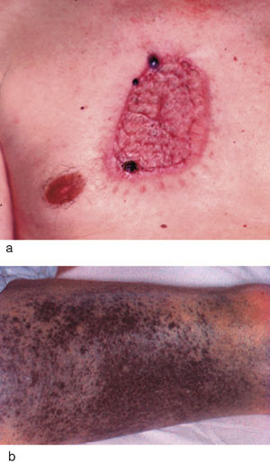 Figur 2  a) Lokalt residiv og b) in transit-metastaser p&aring; l&aring;r. Foto Rikshospitalet-Radiumhospitalet