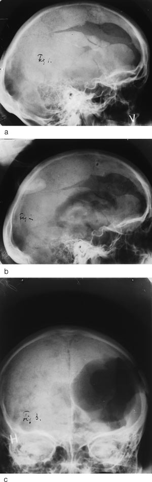 Figur 2  De tre r&oslash;ntgenbildene av pasienten som Monrad-Krohn publiserte bl.a. i tidsskriftet Brain i 1947 (5, 12). a) Bildet&hellip;