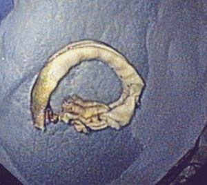 Figur 4  B&aring;ndet etter at det er fjernet aboralt