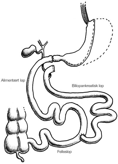 Figur 2  Biliopankreatisk avledning med duodenal omkobling (switch). Det er gjort en partiell langsg&aring;ende gastrektomi&hellip;