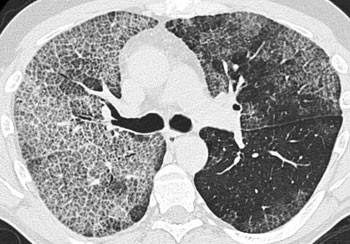 Figur 2  HR-CT-bilde (1 mm snittykkelse) tatt f&oslash;r skylling. S&aelig;rlig i h&oslash;yre lunge er det et diffust sl&oslash;r av alveol&aelig;re&hellip;