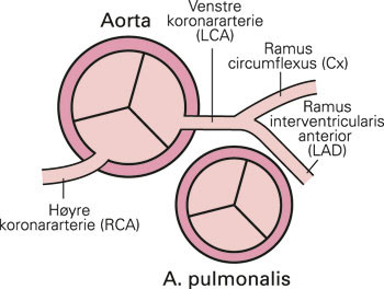  Normalanatomien. Aorta- og pulmonalostiet med avgangen av koronararteriene sett ovenfra