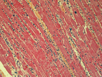 Figur 3  Akutt hjerteinfarkt, alder ca. ett d&oslash;gn