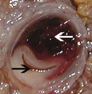 Figur 2  Tverrsnitt av truncus coeliacus. Hvit pil peker p&aring; levret blod i disseksjonsspalten. Svart pil peker p&aring; opprinnelig&hellip;