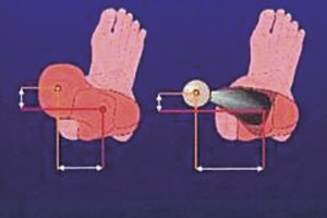 Figur 3  Korreksjon av medial og fremre offset