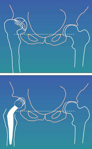 Figur 4  Planlegging av halslengde og halsvinkel