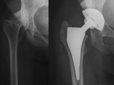Figur 6  53 &aring;r gammel kvinne med hoftedysplasi og beinforkorting, som barn operert med takplastikk