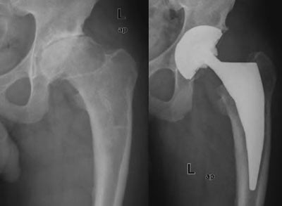 Figur 7  35 &aring;r gammel mann med sekvele etter Calv&eacute;-Legg-Perthes&rsquo; sykdom, som barn operert med femurosteotomi