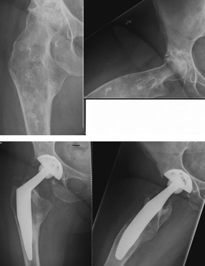 Figur 8  Kvinne 53 &aring;r operert for multiple enkondromer som barn og med uttalt antekurvasjon av emur som gjorde det vanskelig&hellip;