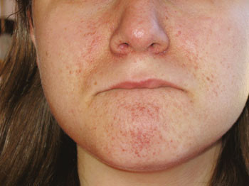 Figur 2  Angiofibromer i ansikt