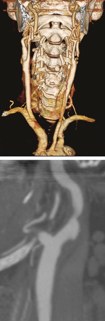 Figur 3  CT-angiografi av halskar, to- og tredimensjonal rekonstruksjon. Foto Rikshospitalet&ndash;Radiumhospitalet