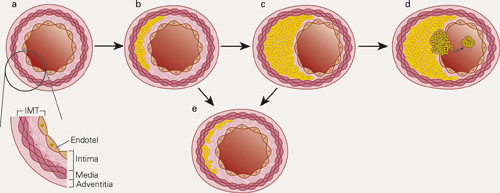 Progrediering av aterosklerose fra en normal arterie (a) til &laquo;det ustabile symptomgivende plakk&raquo; (d). a) Intima-media&hellip;