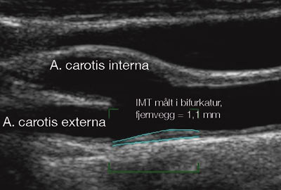 Figur 3  Lett forh&oslash;yet intima-media-tykkelse (IMT) (1,0 mm) hos en ellers frisk 50 &aring;r gammel kvinne. Foto Rikshospitalet&hellip;