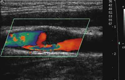 Figur 4  Ultralydbilde av et lavekkogent plakk i a. carotis interna. Embolier fra plakket har gitt flere TIA-anfall. Foto&hellip;