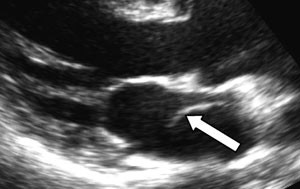 Figur 2  Parasternal langakseavbildning med transtorakal todimensjonal ekkokardiografi. Det kan skimtes en membran i venstre&hellip;