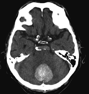 Figur 3  CT-unders&oslash;kelse av 77 &aring;r gammel pasient med cerebell&aelig;r bl&oslash;dning. 4. ventrikkel er helt komprimert, det er et&hellip;