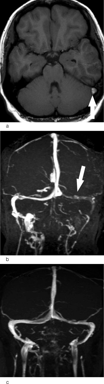 Figur 2  a) T1-vektet bilde i transversalplan. Trombe i venstre sinus sigmoideus (pil) i subakuttfasen er hyperintens. b)&hellip;