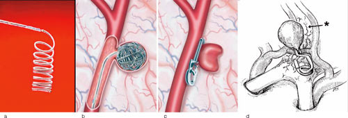 Figur 2  a) Coil festet til innf&oslash;ringslederen. b) Mikrokateter i aneurismet og coiler p&aring;begynt pakket i aneurismet. c)&hellip;