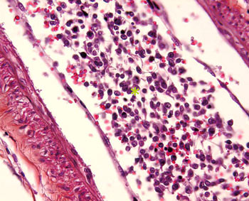 Figur 2  N&aelig;rbilder av kar fylt av abnormt utseende lymfoide celler (stjerne). Hematoksylin-eosin x 60. Foto&hellip;