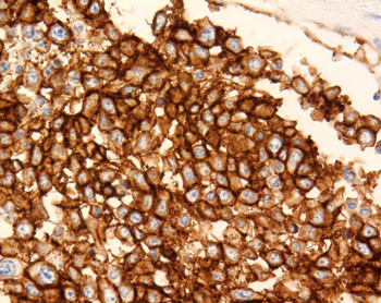 Figur 3  Immunhistokjemisk unders&oslash;kelse viser at tumorcellene er positive for B-cellemark&oslash;ren CD20, i bildet farget brune (x&hellip;
