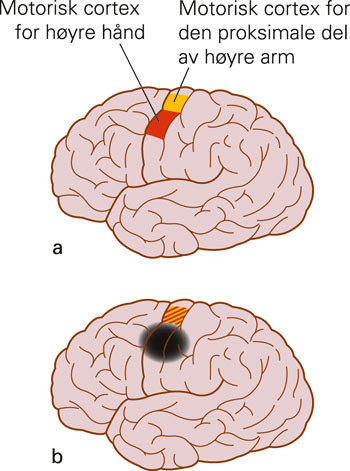 Eksempel p&aring; kortikal reorganisering. a) Omr&aring;dene i venstre hemisf&aelig;res motoriske cortex som styrer h&oslash;yre h&aring;nd (r&oslash;dt) og&hellip;