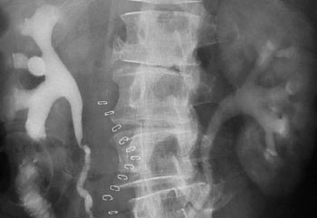 Figur 2  60-minutters bilde (senbilde) tatt ti dager etter operasjon, som viser lett utvidelse p&aring; begge sider og fremdeles&hellip;