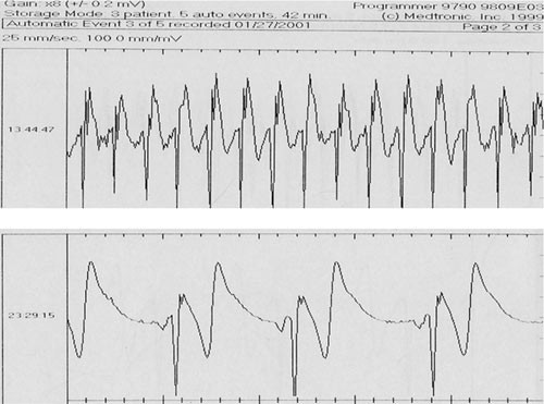 Figur 2  Utskrift fra rytmeoverv&aring;keren viser en episode med supraventrikul&aelig;r takykardi 180/min (&oslash;verst) og bradykardi 42/min&hellip;