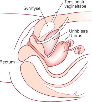 Figur 3  Tensjonsfri vaginaltape