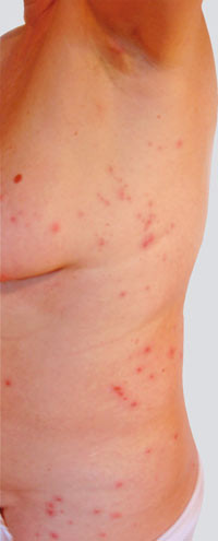 Figur 2  Utbredelse av utslett hos F