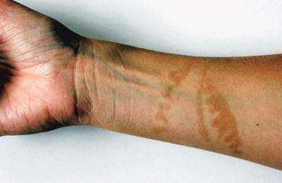 Figur 2  Hyperpigmentering to m&aring;neder etter at omr&aring;det har v&aelig;rt i kontakt med brenntr&aring;dene til maneten, sannsynligvis&hellip;