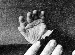 Figur 2  Ole Kristians venstre h&aring;nd fra volarsiden (1)