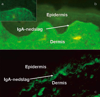 Figur 2  a) Line&aelig;re IgA-nedslag med beskjedne innslag av granul&aelig;rt IgA hos pasienten. b) Typiske line&aelig;re IgA-nedslag hos&hellip;