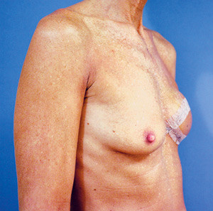 Figur 4  En uke postoperativt