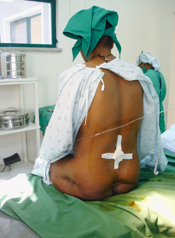 Pasient etter spinalbed&oslash;velse. De tilhelede trykks&aring;rene sier noe om hennes tilstand etter f&oslash;dselen. F&oslash;dslene varer ofte mer&hellip;