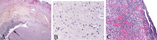 Figur 2 a) Deciduaknuter i appendixveggen med erosjon av slimhinnen (se pil) b) Deciduaceller (x 400) c) Akutt betennelse&hellip;