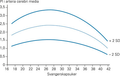 Figur 3 Normal pulsatilitetsindeks (PI) i a. cerebri media i forhold til svangerskapets varighet. PI er normal dersom&hellip;