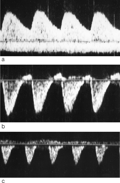 Figur 4 Figuren viser eksempel p&aring; blodstr&oslash;m i a. umbilicalis: a) Normal blodstr&oslash;m ved 32 ukers svangerskap, b) Opphevet&hellip;