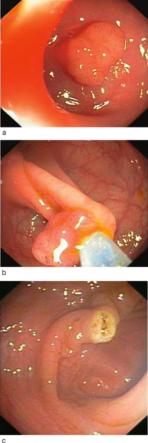 Figur 1  Funn og terapi av premaligne adenomer ved koloskopi. a) Tubul&aelig;rt adenom med moderat dysplasi i colon sigmoideum, 10&hellip;